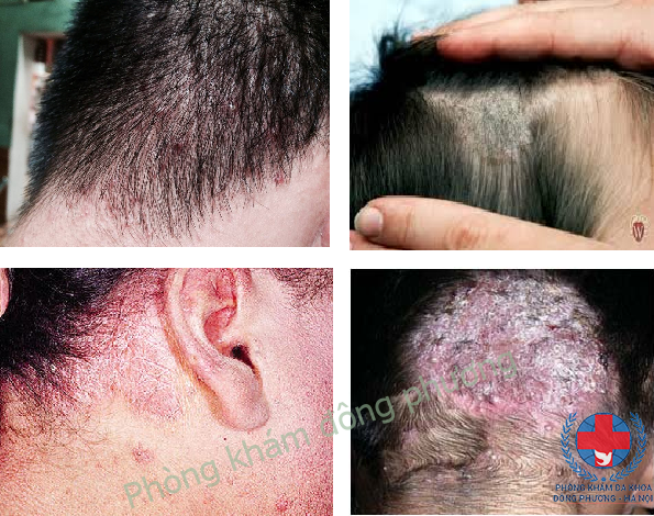 Bệnh nấm da đầu là gì