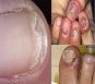 Bệnh nấm móng chân, móng tay – Cách chữa nấm móng tay, móng chân
