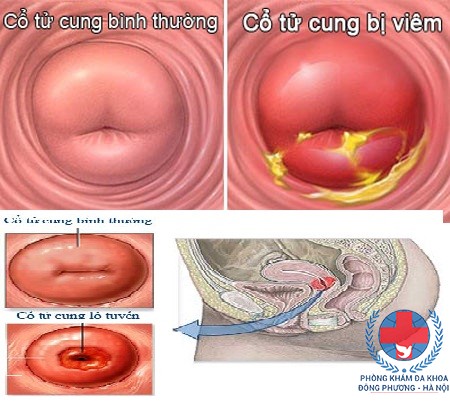 viêm cổ tử cung