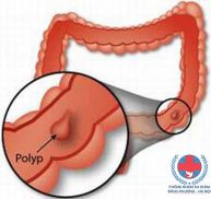 Polyp hậu môn và cách điều trị polyp hậu môn