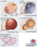 Dấu hiệu u nang buồng trứng và cách điều trị