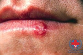 Bệnh herpes – nguyên nhân, triệu chứng, cách chữa trị