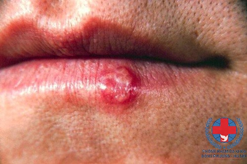 Bệnh herpes gây ra mụn nước ở môi