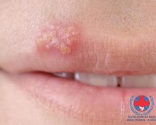 3 lý do khiến herpes môi không ngừng tấn công bạn