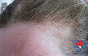 Các dấu hiệu nhận biết nấm da đầu