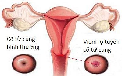 Viêm lộ tuyến cổ tử cung là gì