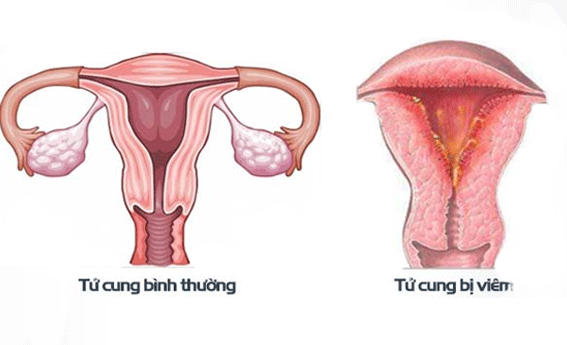 Viêm nội mạc tử cung sau khi hút thai