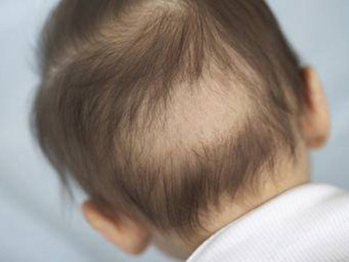 Rụng tóc vành khăn thường xuất hiện ở trẻ nhỏ