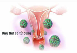 Ung thư cổ tử cung là gì?
