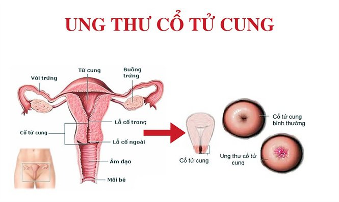 Ung Thu Tu Cung 1