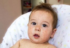 Bệnh bạch biến ở trẻ em: Dấu hiệu nhận biết & cách điều trị