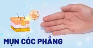 3 Cách trị mụn cơm phẳng trên mặt hiệu quả