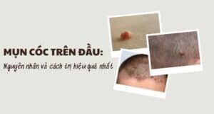 Cách trị mụn cóc trên đầu: Nên dùng thuốc hay tiểu phẫu