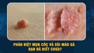 Phân biệt mụn cóc và sùi mào gà?