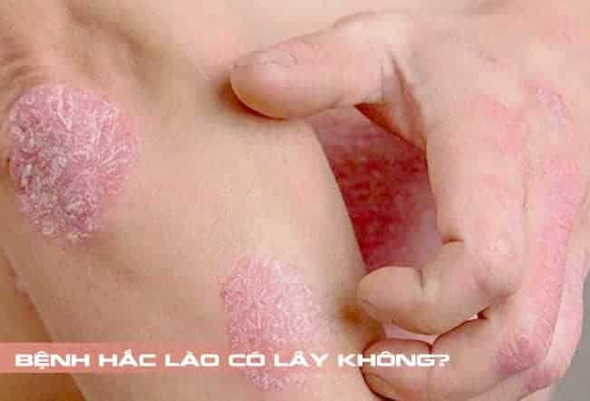 Bệnh hắc lào có lây không?