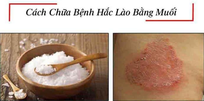 Cách chữa hắc lào bằng muối