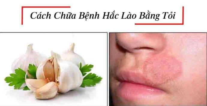 Cách chữa hắc lào bằng tỏi