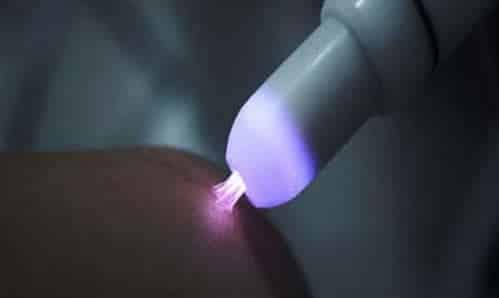 Đốt sùi mào gà bằng laser bao lâu thì khỏi