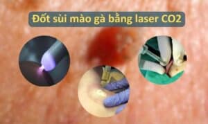 Đốt sùi mào gà bằng laser: Giải pháp hiệu quả từ Phòng Khám Đông Phương