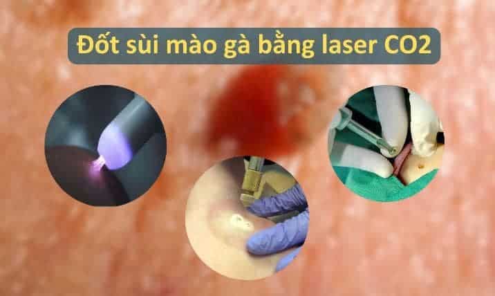 Đốt sùi mào gà bằng laser co2