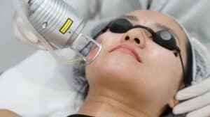 Tẩy nốt ruồi bằng laser ở đâu tốt? Giá tẩy nốt ruồi là bao nhiêu?