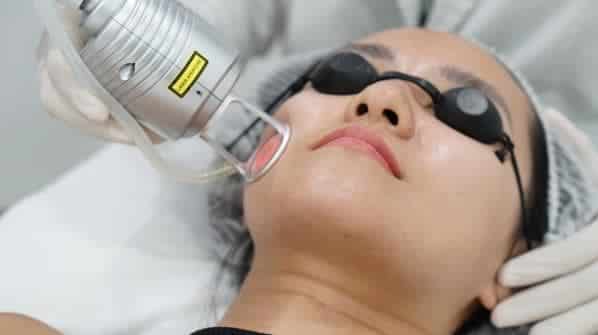 Máy laser tẩy nốt ruồi