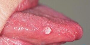 Sùi mào gà ở lưỡi giai đoạn đầu: Nguyên nhân, triệu chứng và cách điều trị