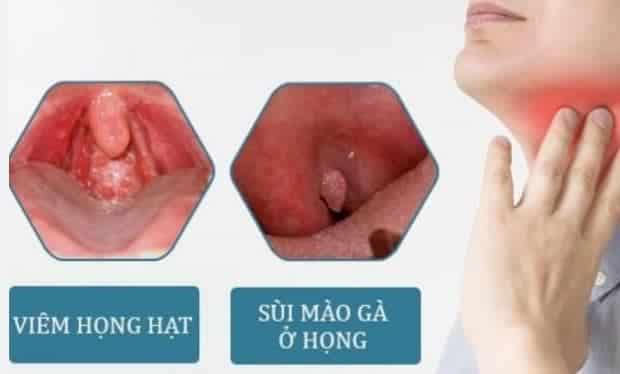 Phân biệt viêm họng hạt và sùi mào gà