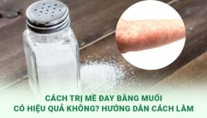 Cách trị mề đay bằng muối: Giải pháp tự nhiên hiệu quả