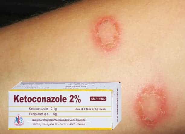 Ưu điểm của ketoconazole trị hắc lào