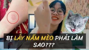 Bệnh nấm mèo ở người: Nguyên nhân, triệu chứng và cách điều trị hiệu quả