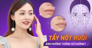 Tẩy nốt ruồi có ảnh hưởng đến tướng số không?